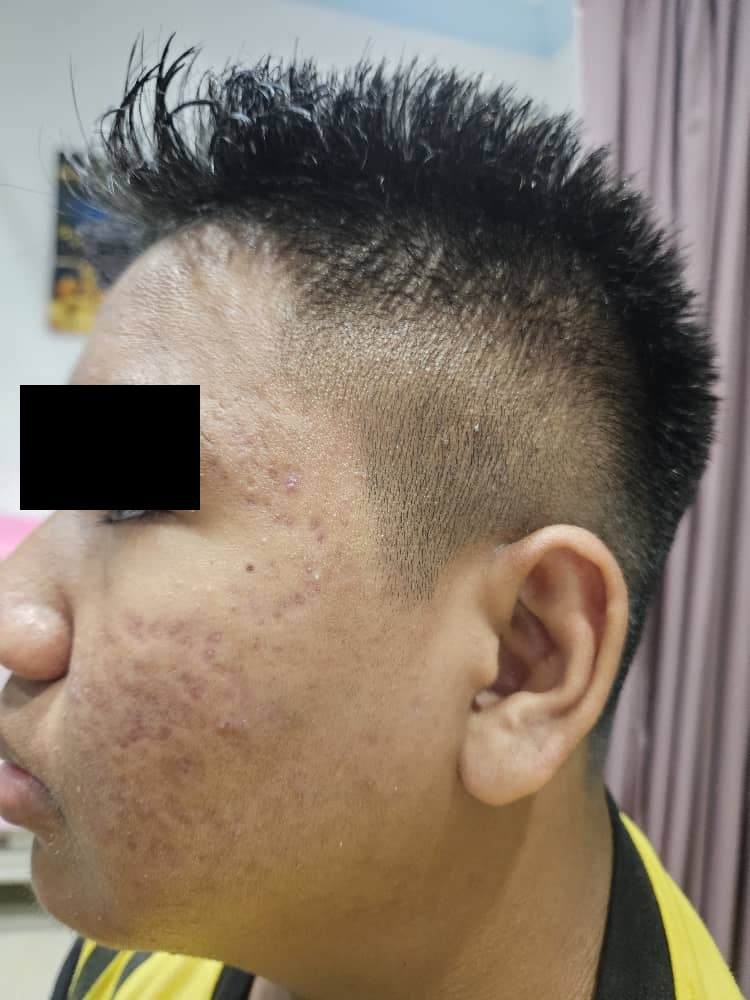 Facial acne after treatment